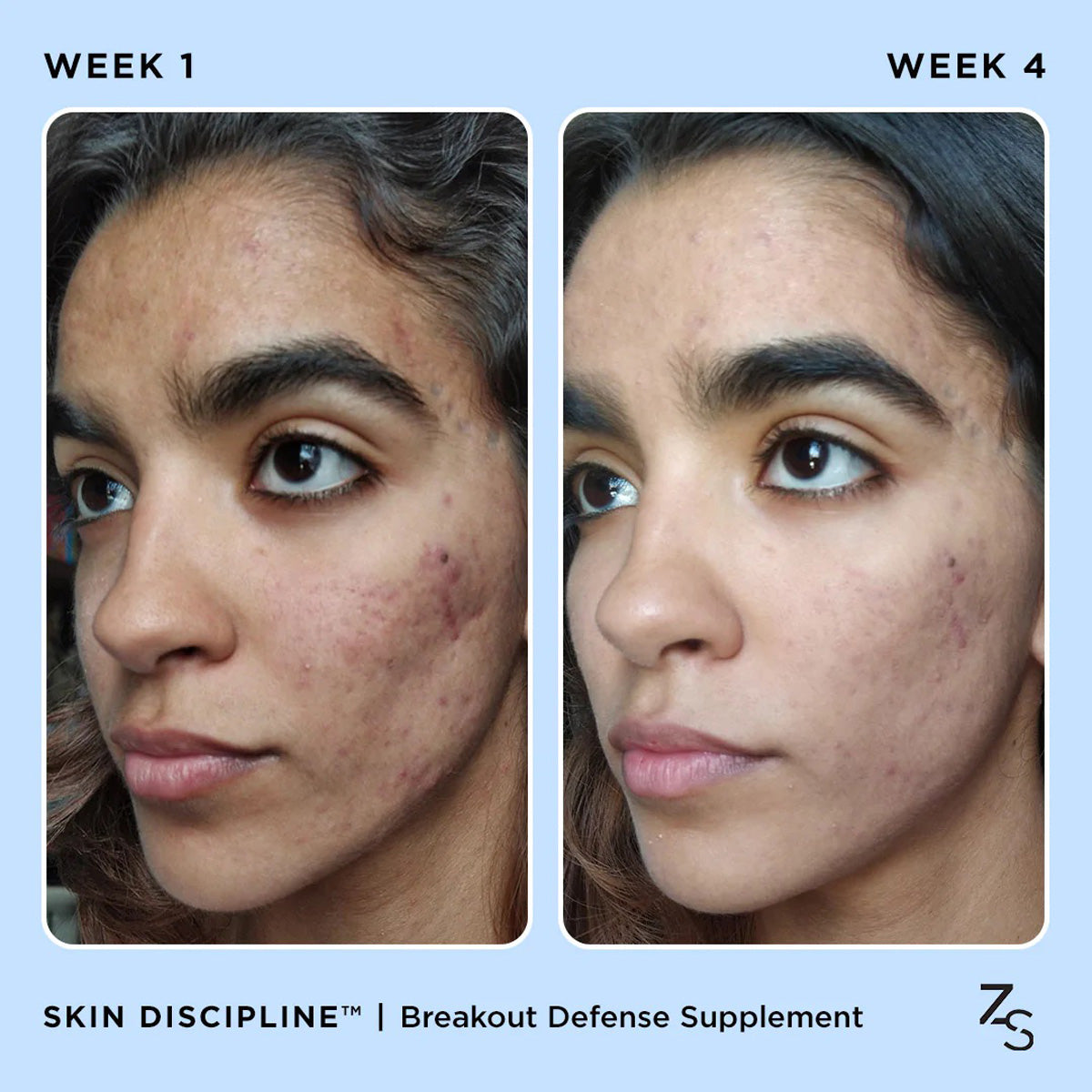 ZitSticka SKIN DISCIPLINE before and after
