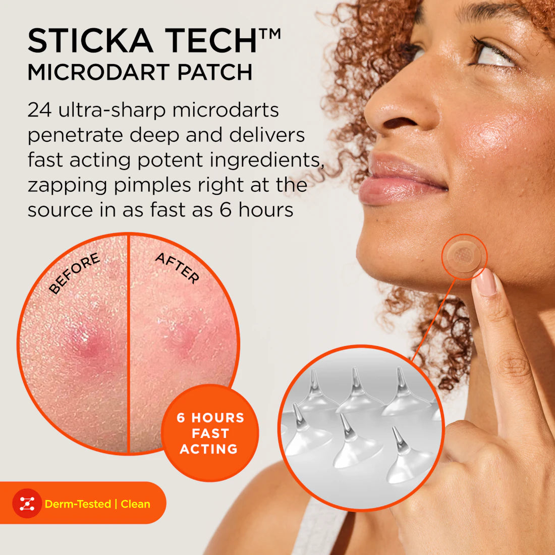 Woman applying KILLA Kit microdart patch; inset shows acne results before and after 6 hours.