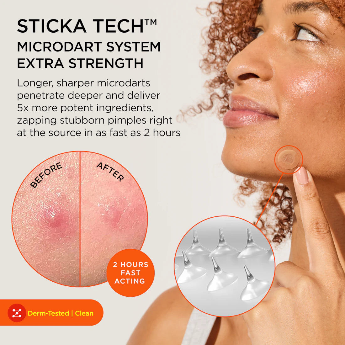 Woman uses KILLA ACNE Extra Strength Microdart Patch on her cheek; shows before-and-after results.