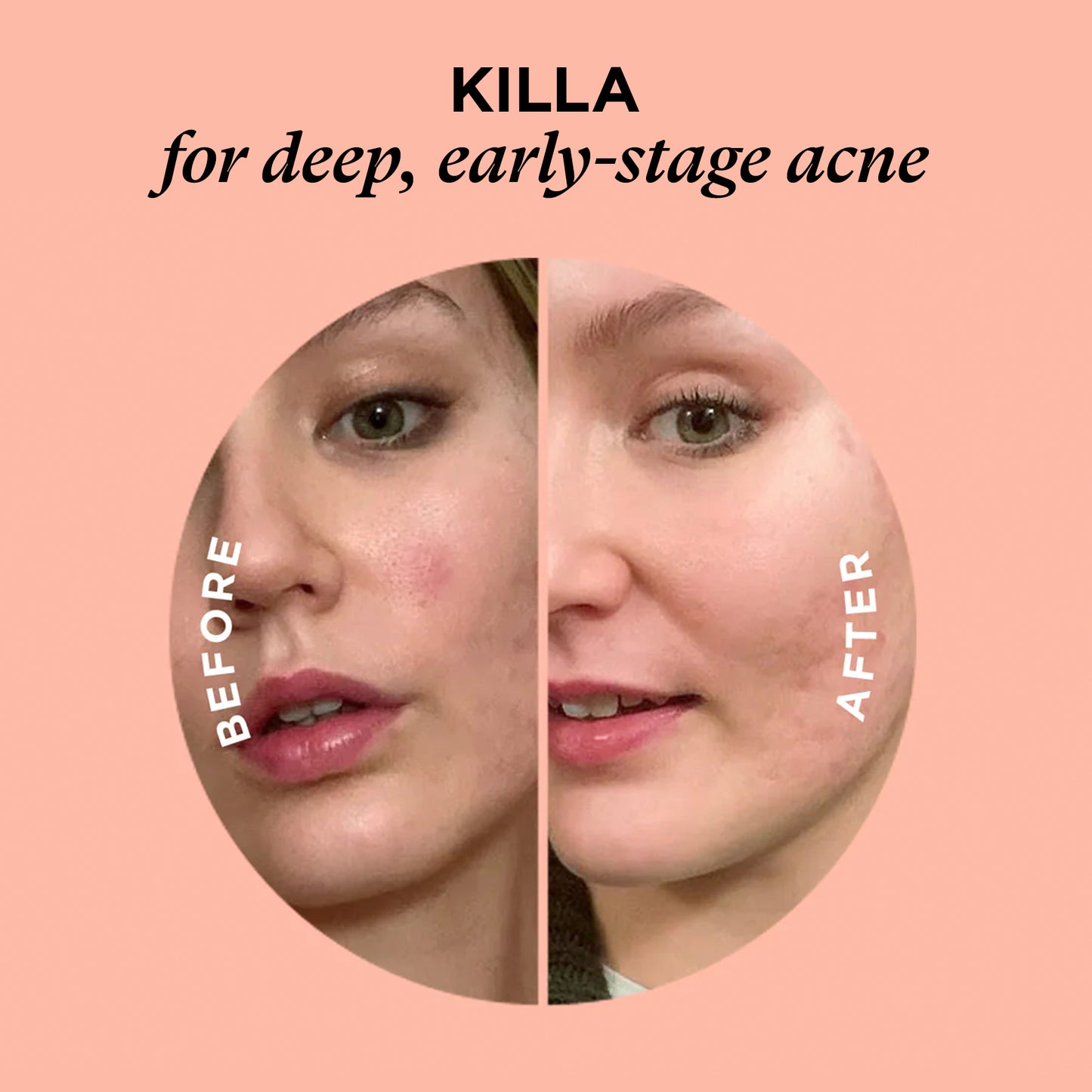 Side-by-side close-ups of a woman’s face showing acne before and after using the SOS KIT patches.