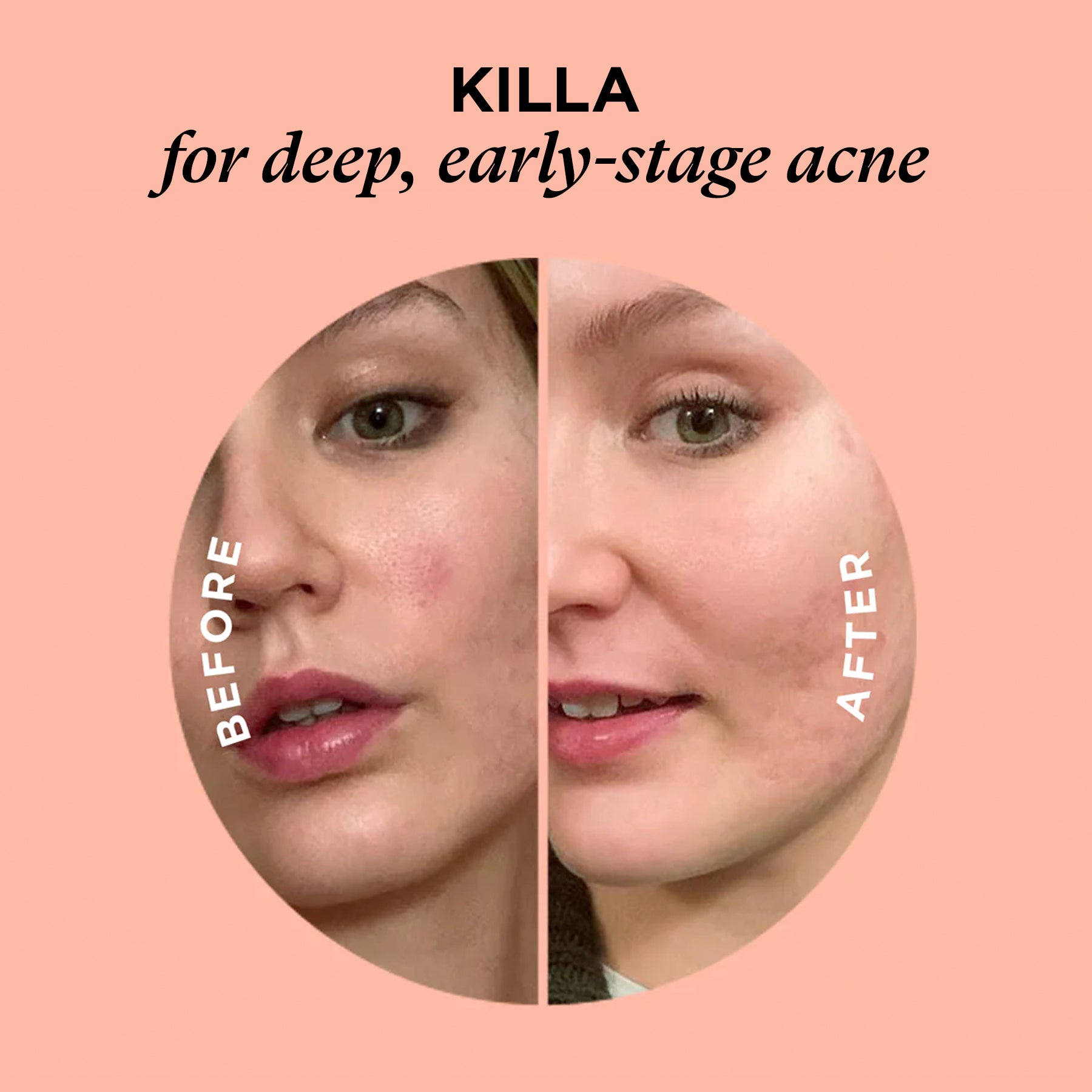 Side-by-side close-ups of a woman’s face showing acne before and after using the SOS KIT patches.