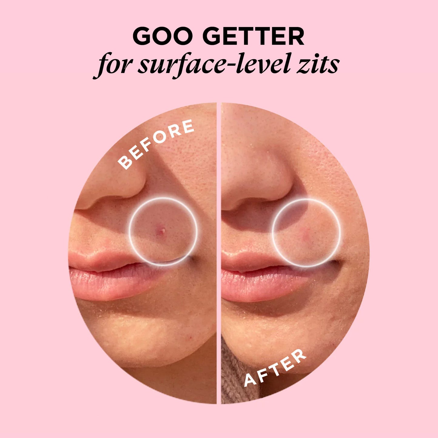 Before and after photos show a zit shrinking with SOS KIT microdart patches on someones cheek.