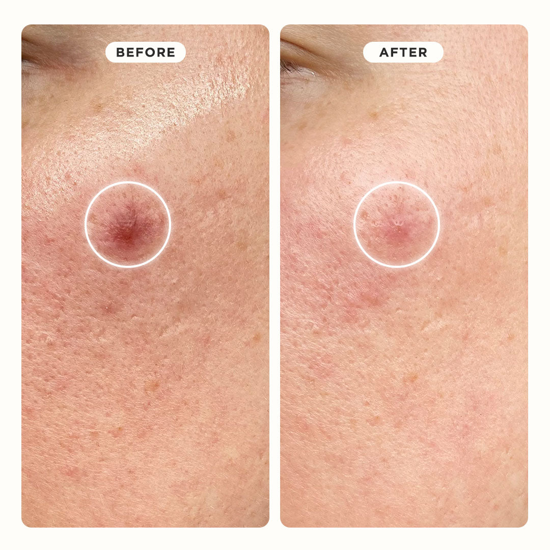 Close-up of cheek with pimple marks before and after using HYPERFADE Microdart Blur Patches.