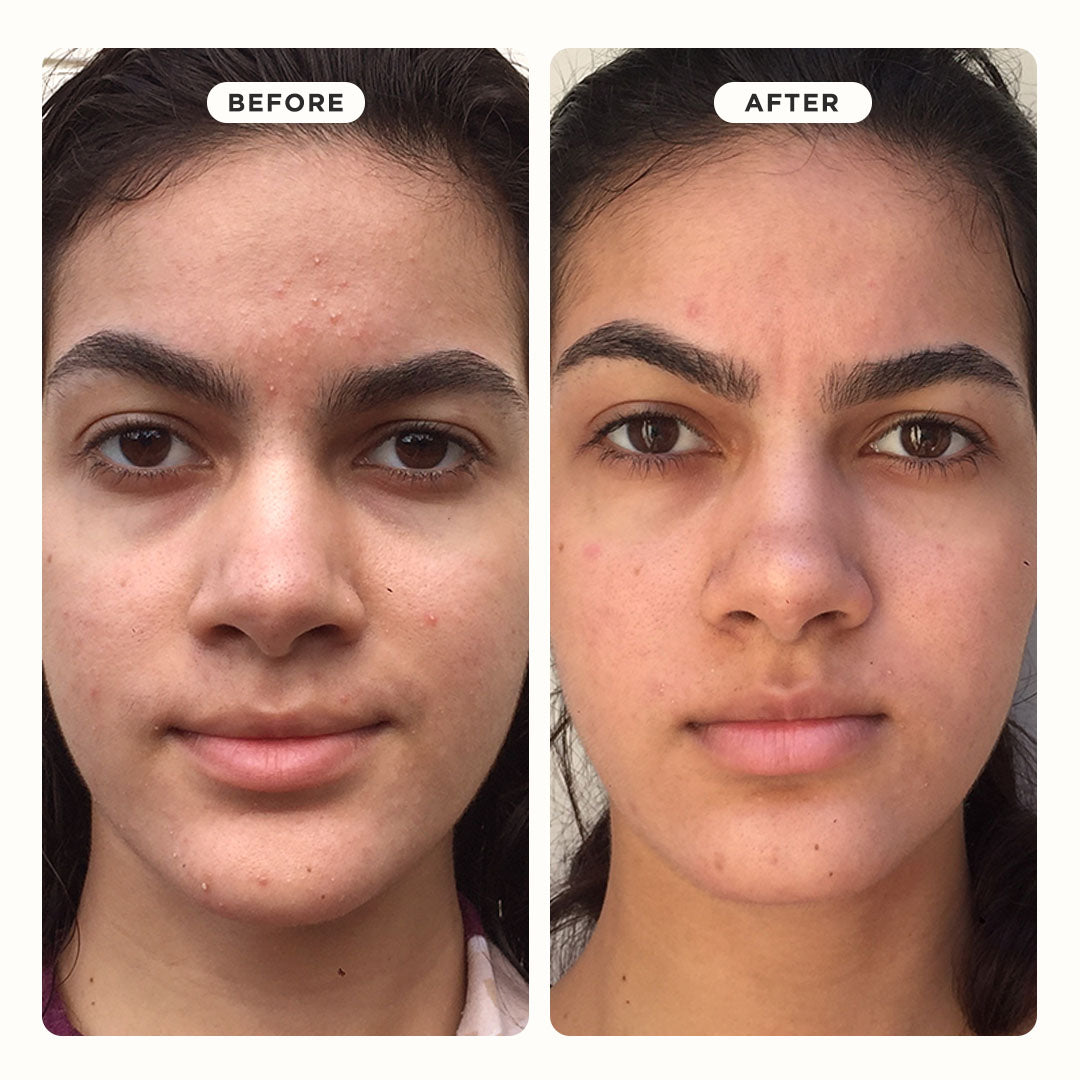 Before and after using PORE VAC Clearing Clay Mask—skin appears clearer and less congested.