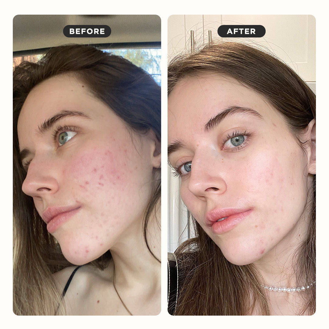 Side-by-side of a womans face before and after using the PRESS REFRESH exfoliating sheet mask.