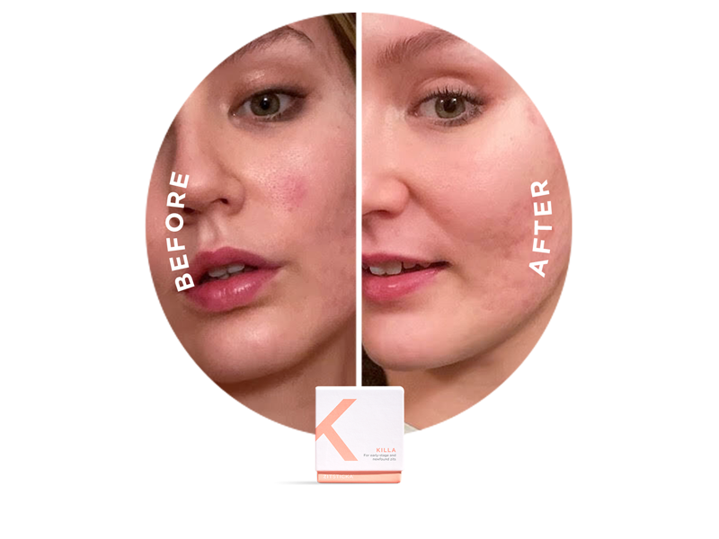 A woman’s face before and after using PATCH IT UP—clearer skin and faded post-zit dark spots.