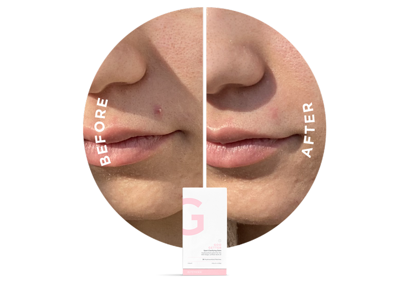 Side-by-side close-up of a chin before and after PATCH IT UP hydrocolloid blemish treatment.