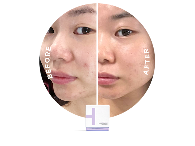 PATCH IT UP hydrocolloid patches visibly reduce blemishes after acne treatment in side-by-side tests.