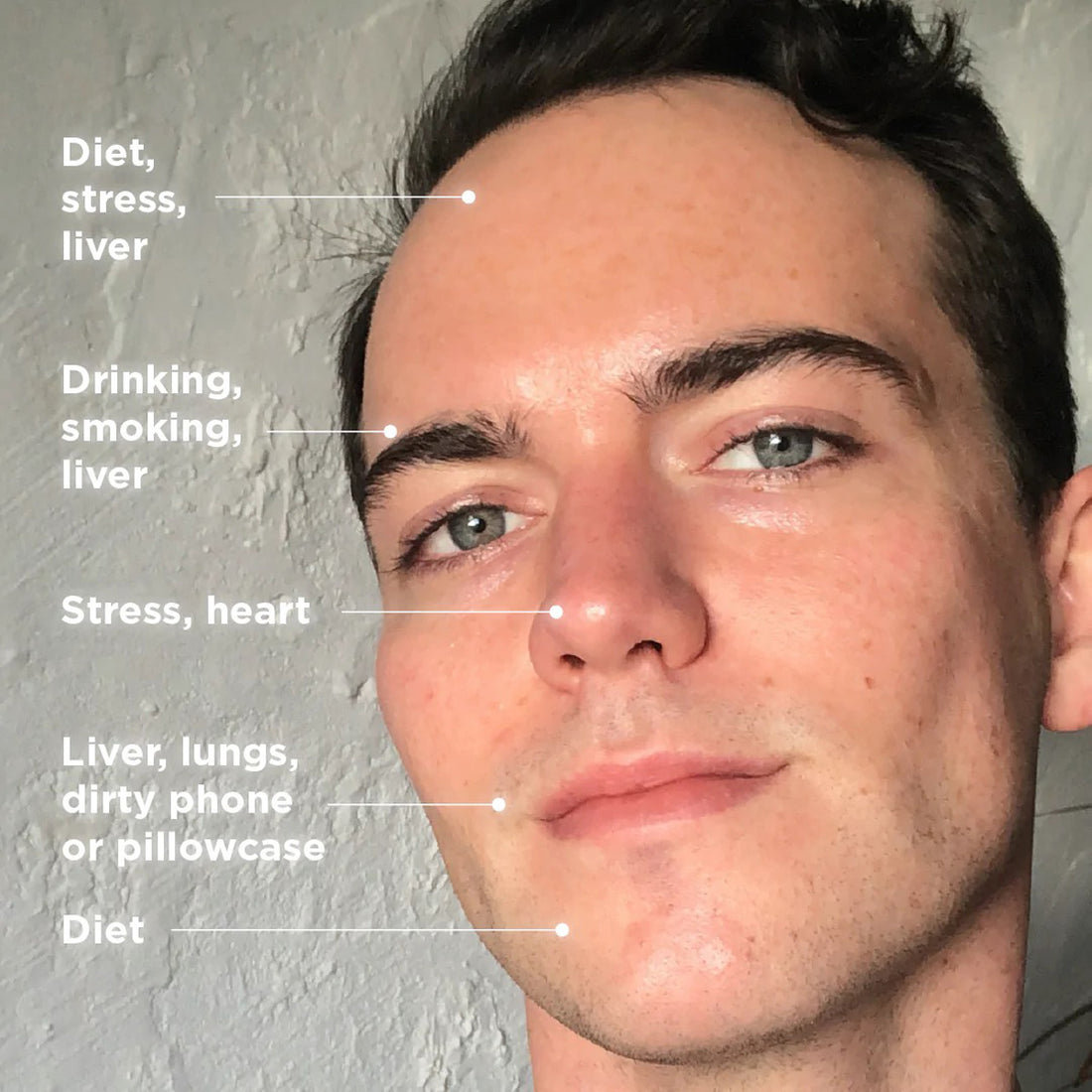 Can 'Face Mapping' Reveal <i>Why</i> You Break Out?!