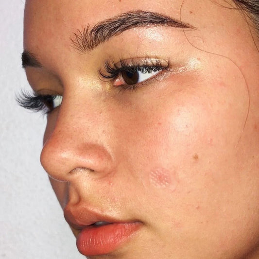 Aloha Lau wears ZitSticka pimple patch