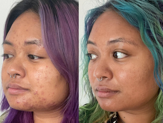 Expensive Skin Brightening Treatments vs. BLUR POTION