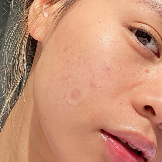 Important: Do You Know What Kind of Zit You Have?
