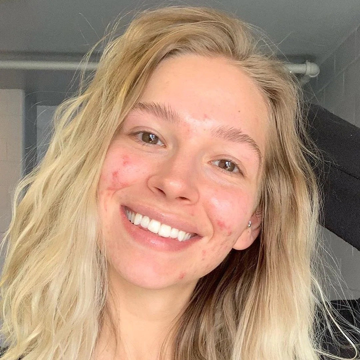 A blonde smiling girl with some acne