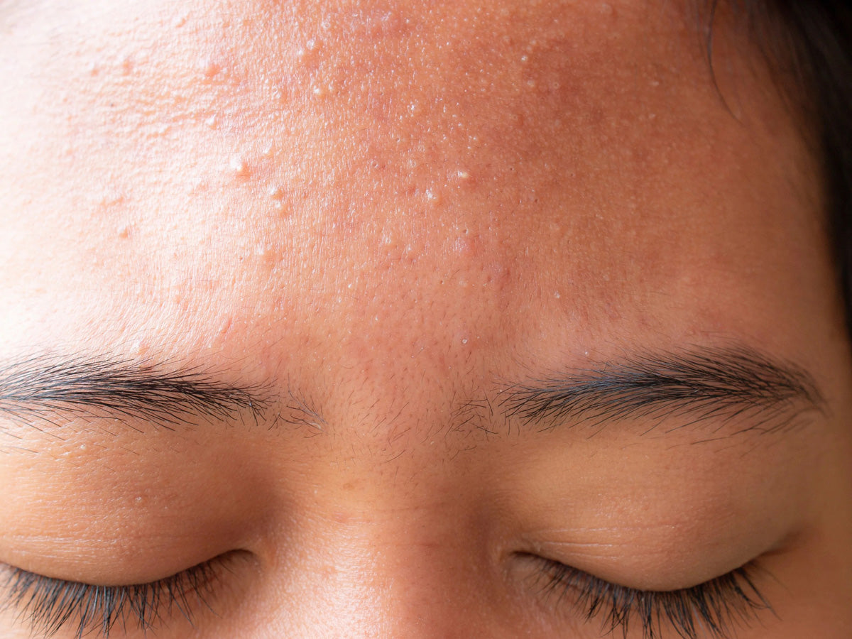 pimples on forehead causes