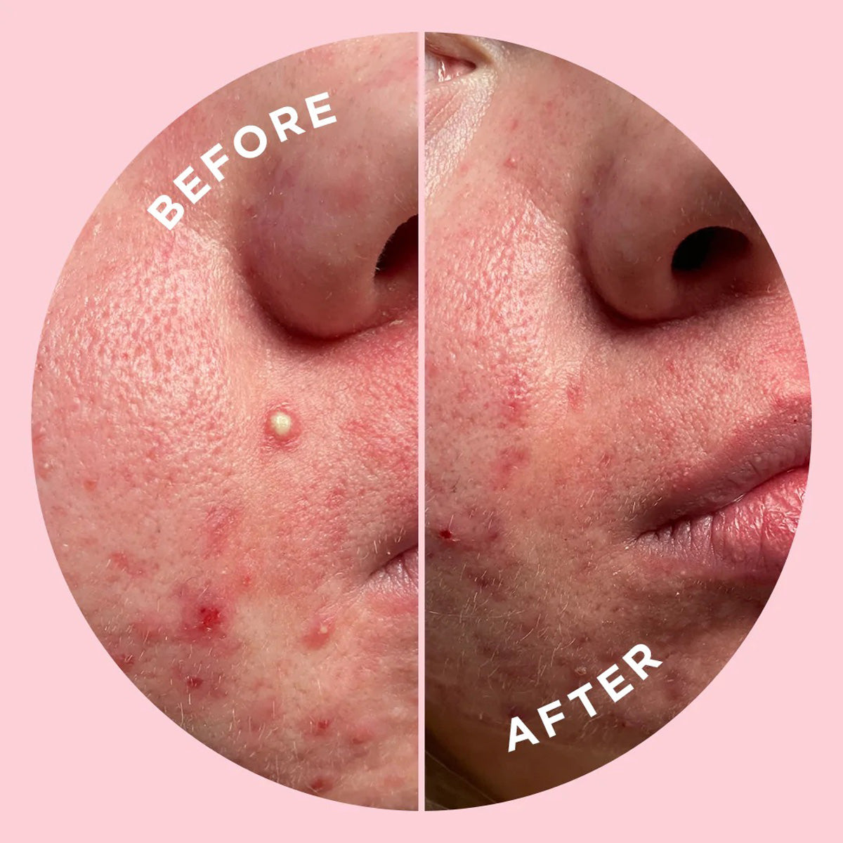 Zit Object Popping Pimples