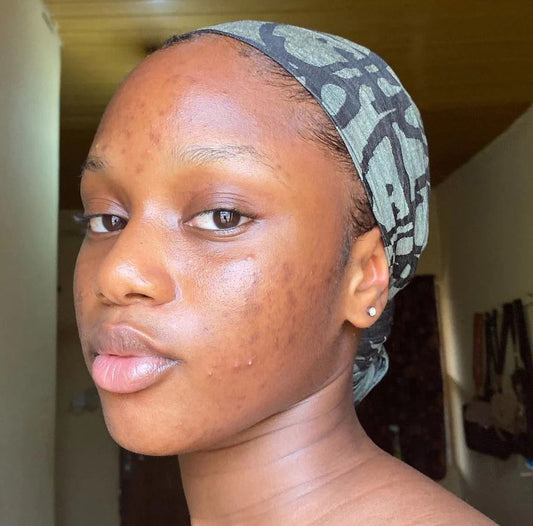Brown-skinned girl with hyperpigmentation