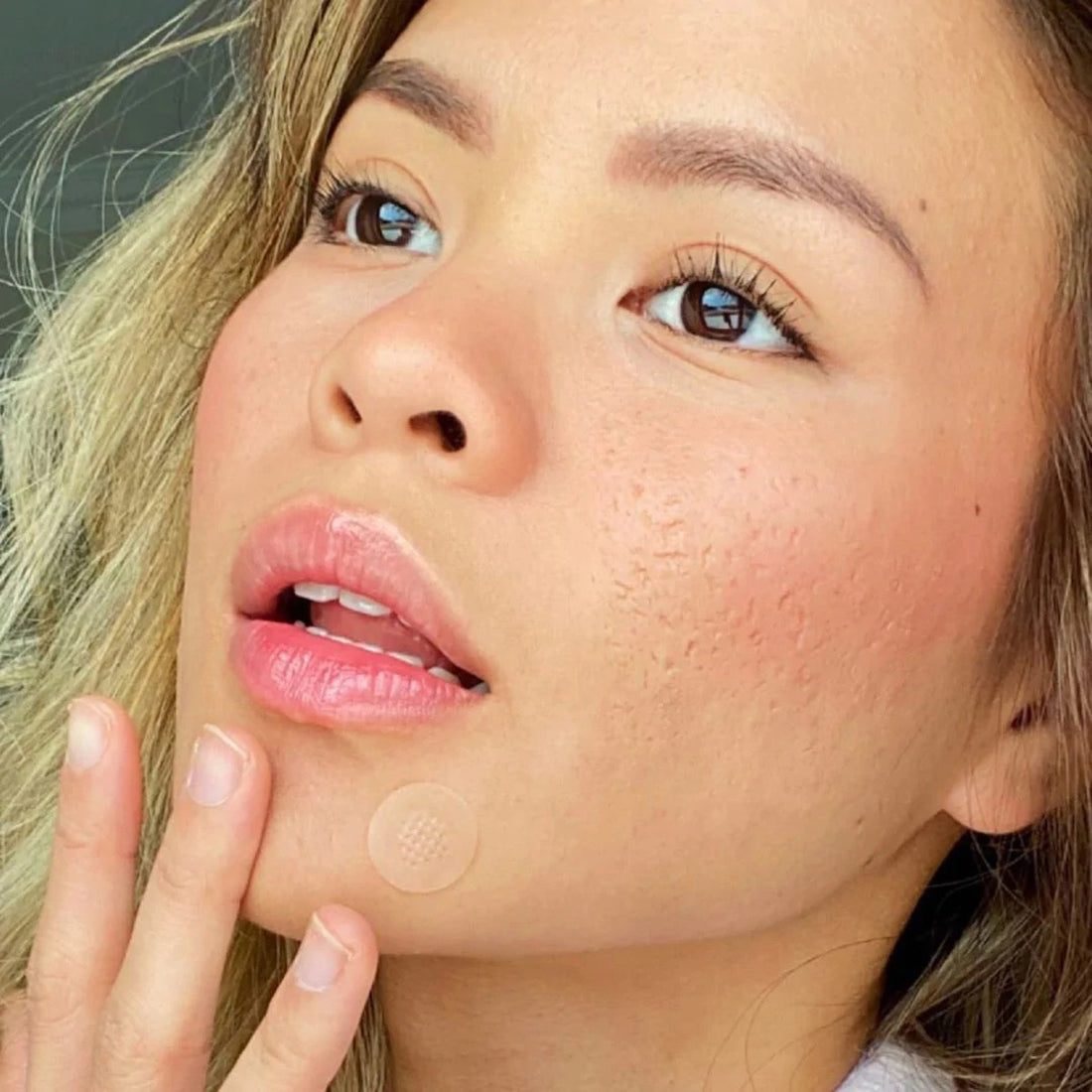 ZitSticka hyperpigmentation is not scarring