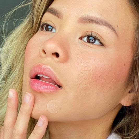ZitSticka hyperpigmentation is not scarring