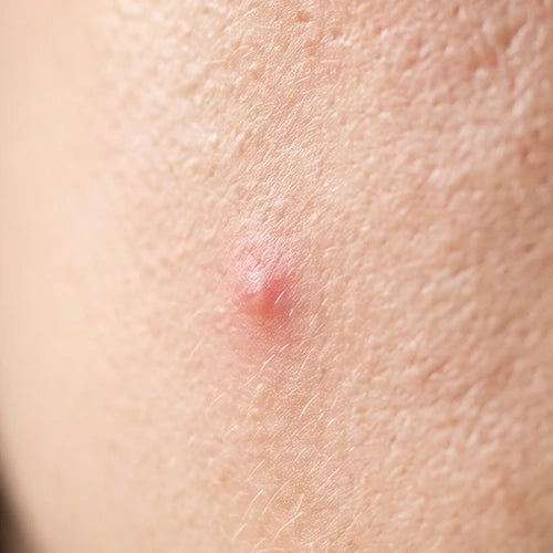 Zit Object Home | ZitSticka™ | Clear-Skin Toolkit