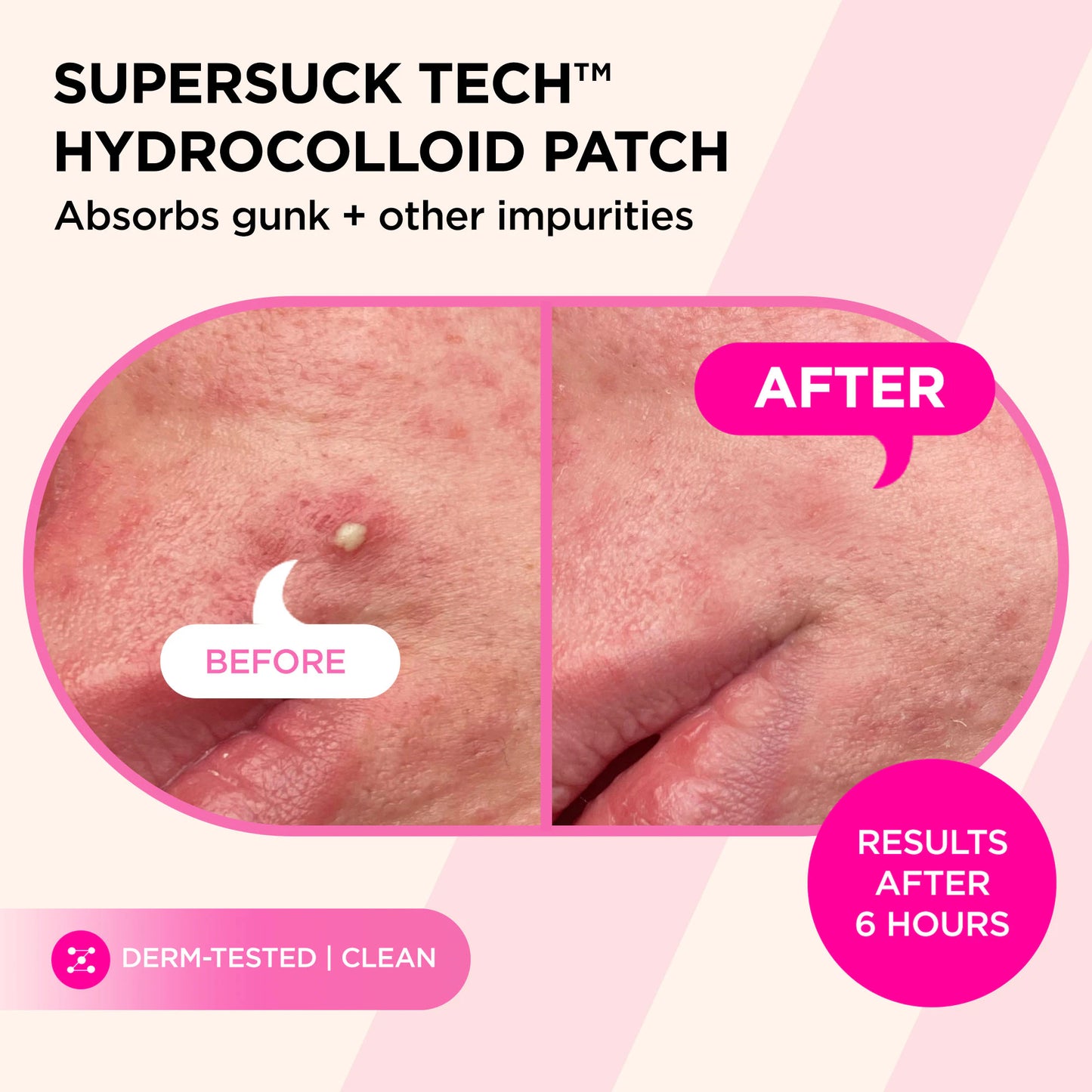 Before and after of a pimple treated with SUCKS TO BE GOO Kit, showing visibly clearer skin.