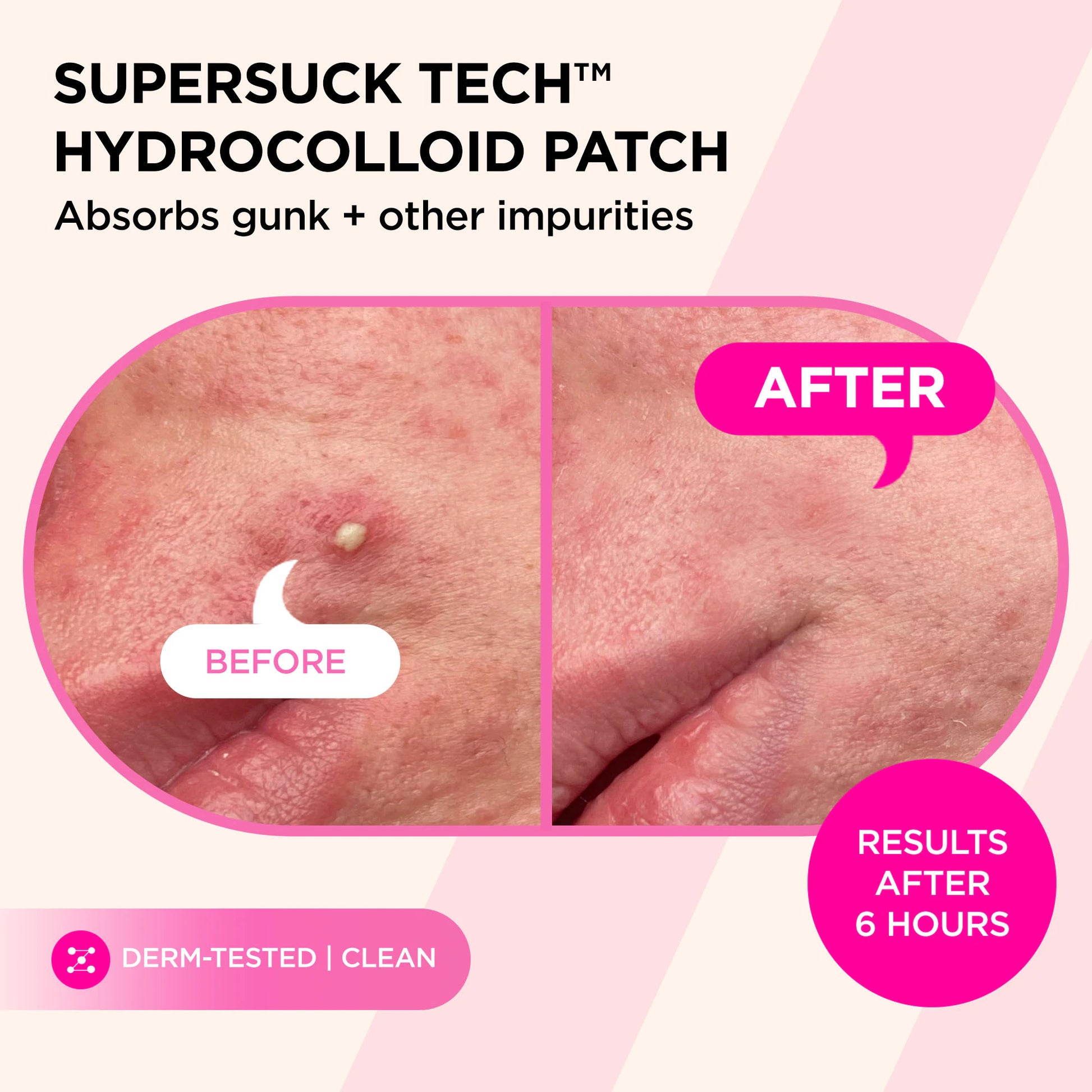 Before and after of a pimple treated with SUCKS TO BE GOO Kit, showing visibly clearer skin.