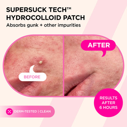 Before and after of a pimple treated with SUCKS TO BE GOO Kit, showing visibly clearer skin.