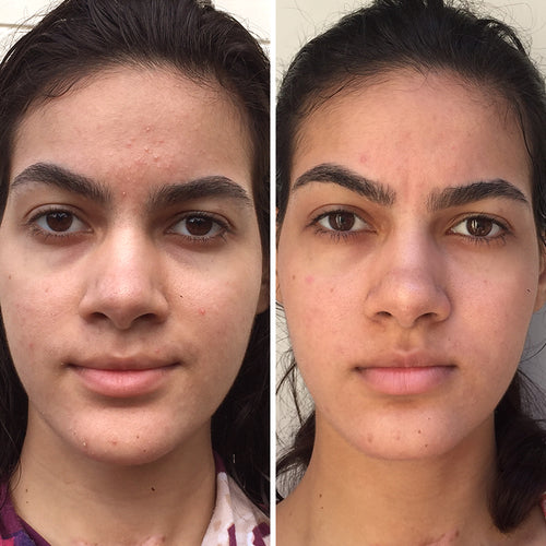 PORE VAC™